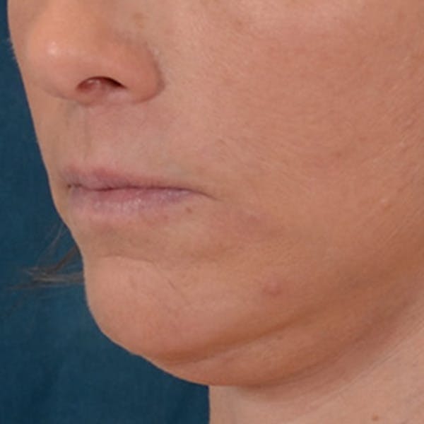 Lip Lift Before & After Gallery - Patient 125162 - Image 8