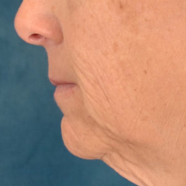 Lip Lift Before & After Gallery - Patient 125162 - Image 9