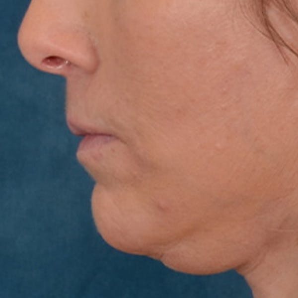 Lip Lift Before & After Gallery - Patient 125162 - Image 10