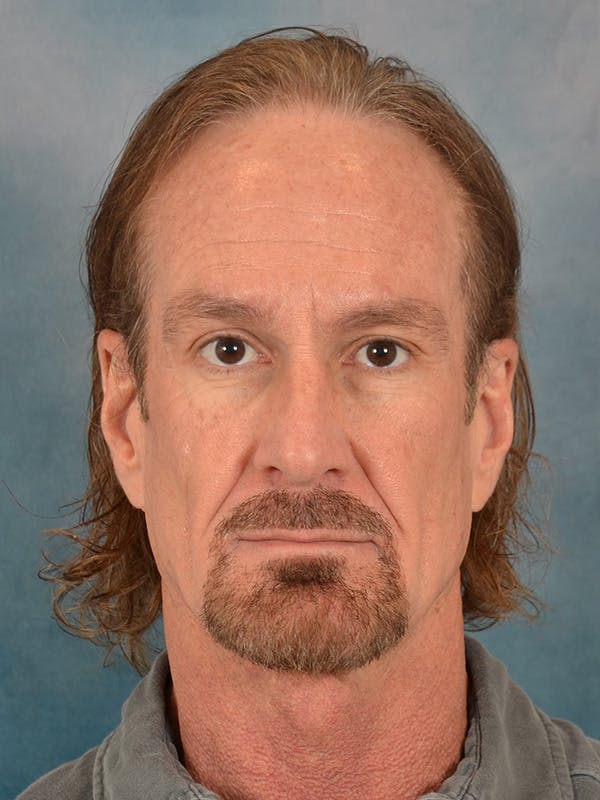 Deep Neck Lift Before & After Gallery - Patient 360372 - Image 1