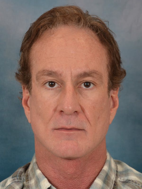 Deep Neck Lift Before & After Gallery - Patient 360372 - Image 2