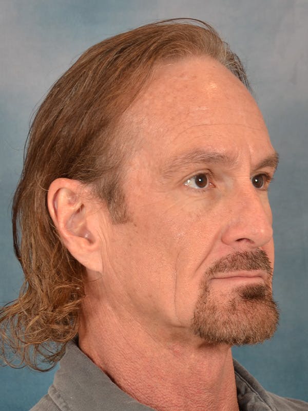 Deep Neck Lift Before & After Gallery - Patient 360372 - Image 7