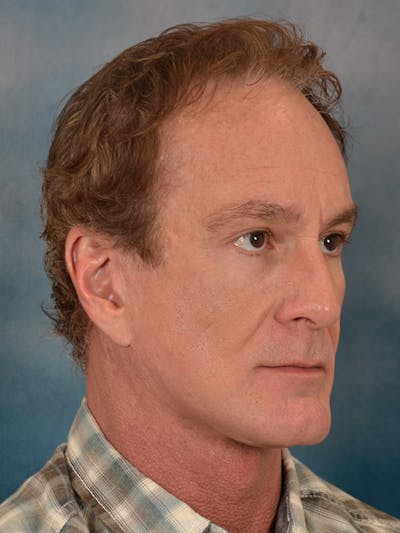 Deep Neck Lift Before & After Gallery - Patient 360372 - Image 8