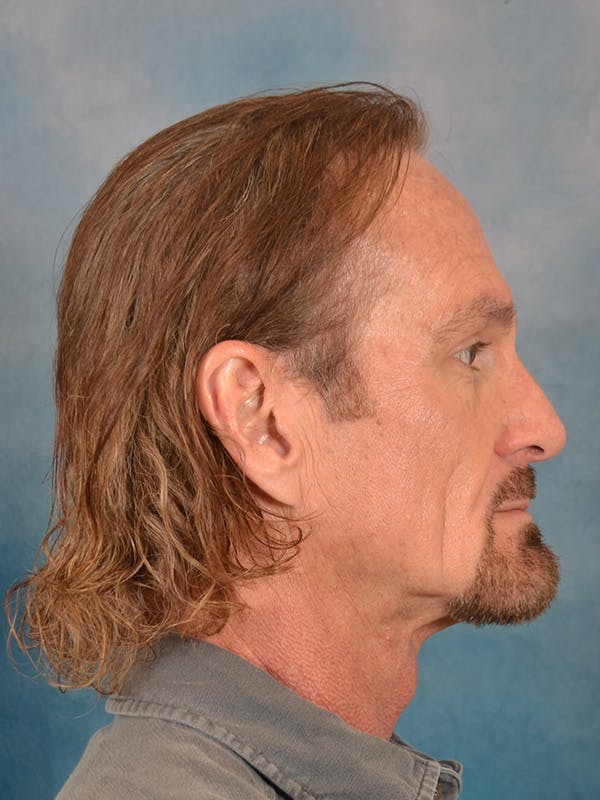 Deep Neck Lift Before & After Gallery - Patient 360372 - Image 9