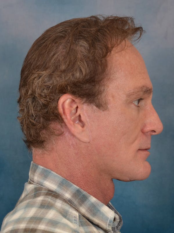 Deep Neck Lift Before & After Gallery - Patient 360372 - Image 10