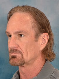 Deep Plane Facelift Before & After Gallery - Patient 148969 - Image 1