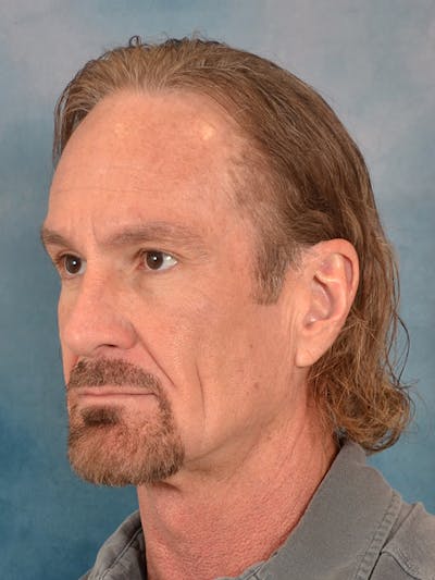 Deep Plane Facelift Before & After Gallery - Patient 148969 - Image 1