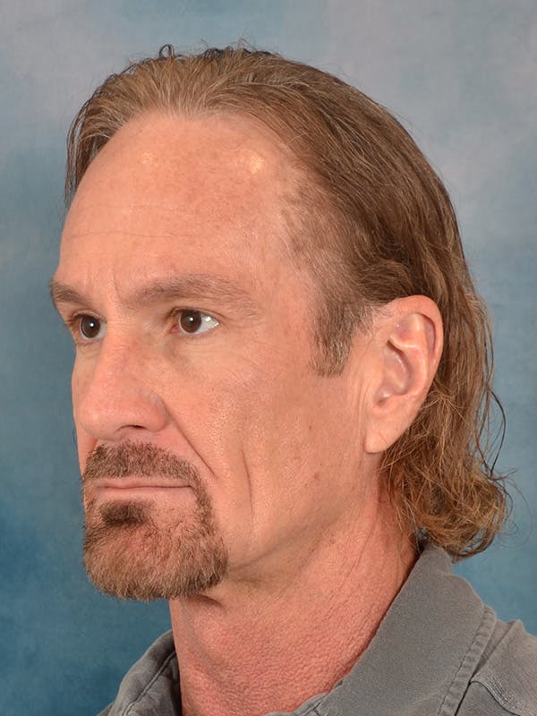 Deep Neck Lift Before & After Gallery - Patient 360372 - Image 3