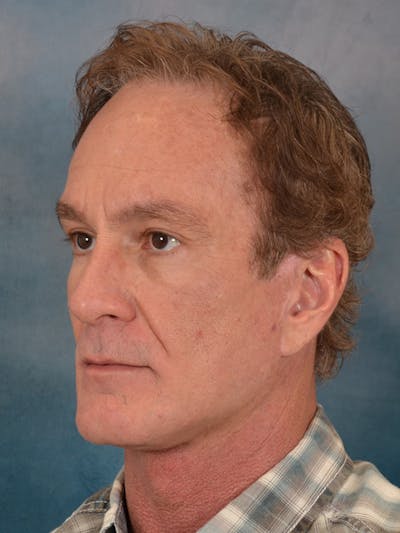 Deep Neck Lift Before & After Gallery - Patient 360372 - Image 4