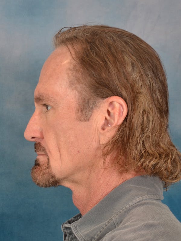 Deep Neck Lift Before & After Gallery - Patient 360372 - Image 5