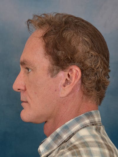 Deep Neck Lift Before & After Gallery - Patient 360372 - Image 6