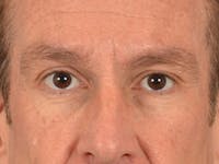Eyelid Lift Before & After Gallery - Patient 605463 - Image 1