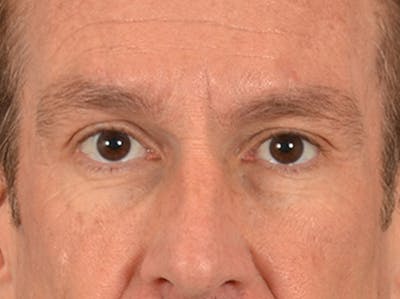 Eyelid Lift Before & After Gallery - Patient 742743 - Image 1