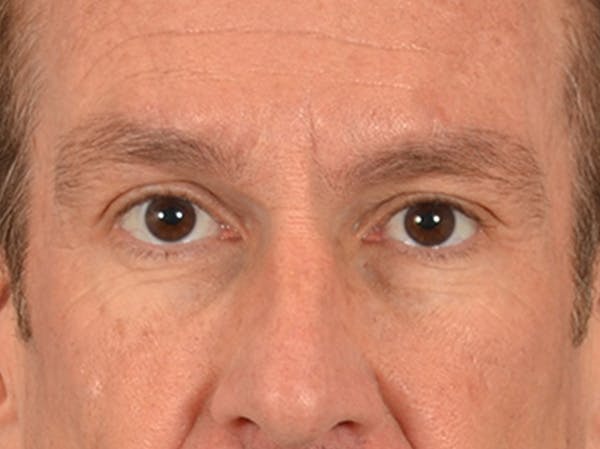 Eyelid Lift Before & After Gallery - Patient 605463 - Image 1