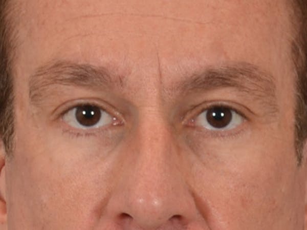 Eyelid Lift Before & After Gallery - Patient 605463 - Image 2