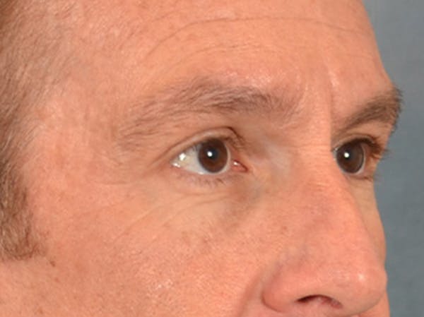 Eyelid Lift Before & After Gallery - Patient 605463 - Image 3