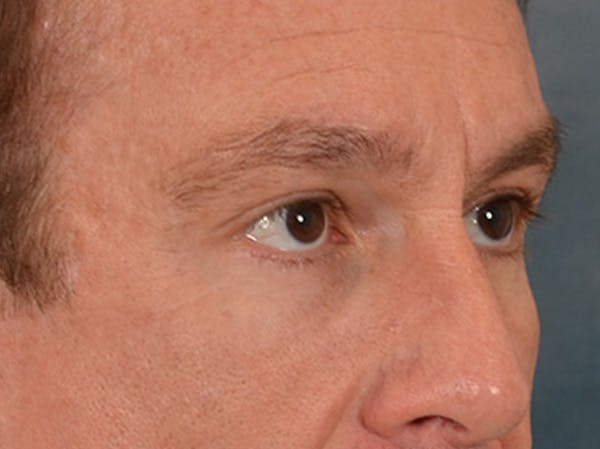 Eyelid Lift Before & After Gallery - Patient 605463 - Image 4