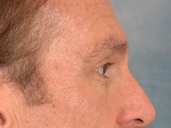 Eyelid Lift Before & After Gallery - Patient 605463 - Image 5