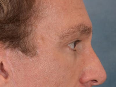 Eyelid Lift Before & After Gallery - Patient 605463 - Image 6