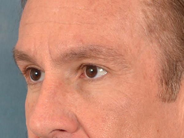 Eyelid Lift Before & After Gallery - Patient 605463 - Image 7