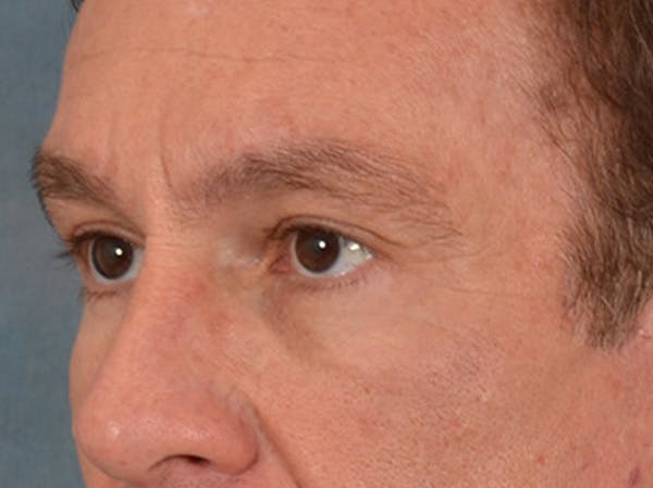 Eyelid Lift Before & After Gallery - Patient 605463 - Image 8