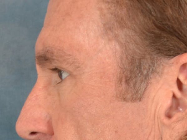 Eyelid Lift Before & After Gallery - Patient 605463 - Image 9