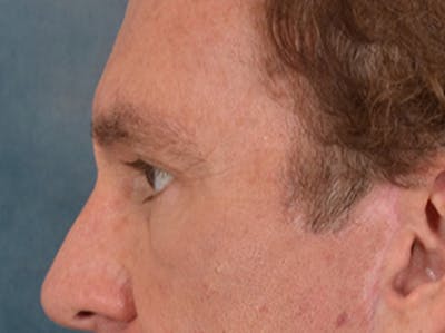 Eyelid Lift Before & After Gallery - Patient 605463 - Image 10