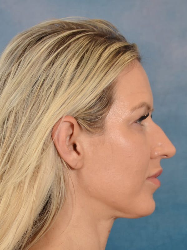 Rhinoplasty Before & After Gallery - Patient 387488 - Image 9