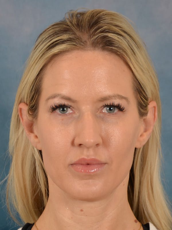 Rhinoplasty Before & After Gallery - Patient 387488 - Image 5