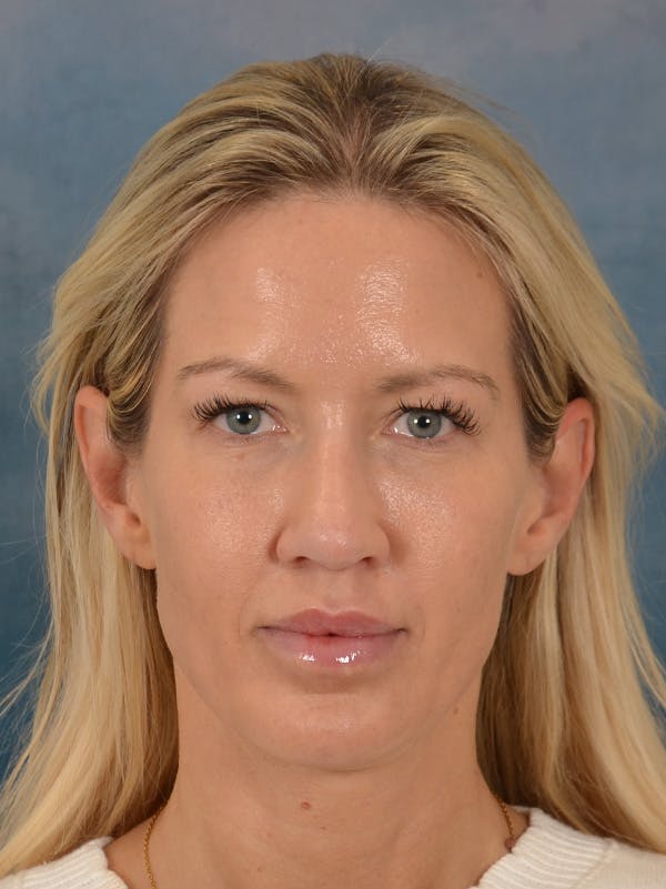 Rhinoplasty Before & After Gallery - Patient 387488 - Image 6