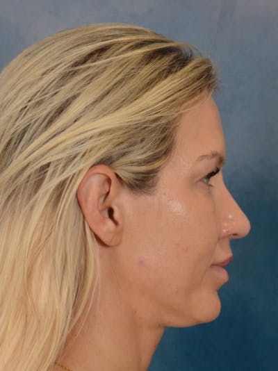 Rhinoplasty Before & After Gallery - Patient 387488 - Image 10