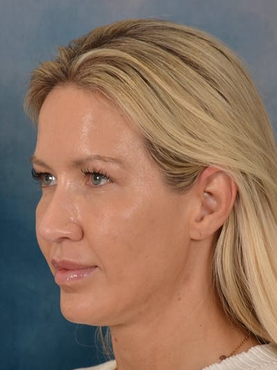 Rhinoplasty Before & After Gallery - Patient 387488 - Image 4