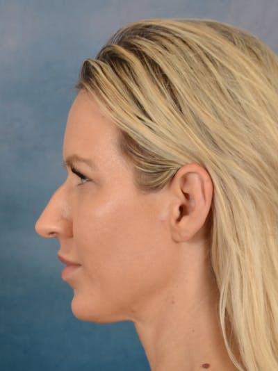 Rhinoplasty Before & After Gallery - Patient 544468 - Image 1