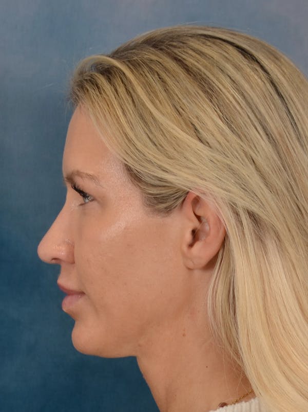 Rhinoplasty Before & After Gallery - Patient 387488 - Image 2