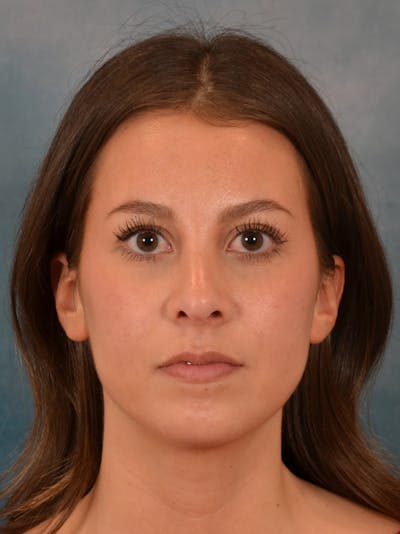 Rhinoplasty Before & After Gallery - Patient 544468 - Image 6