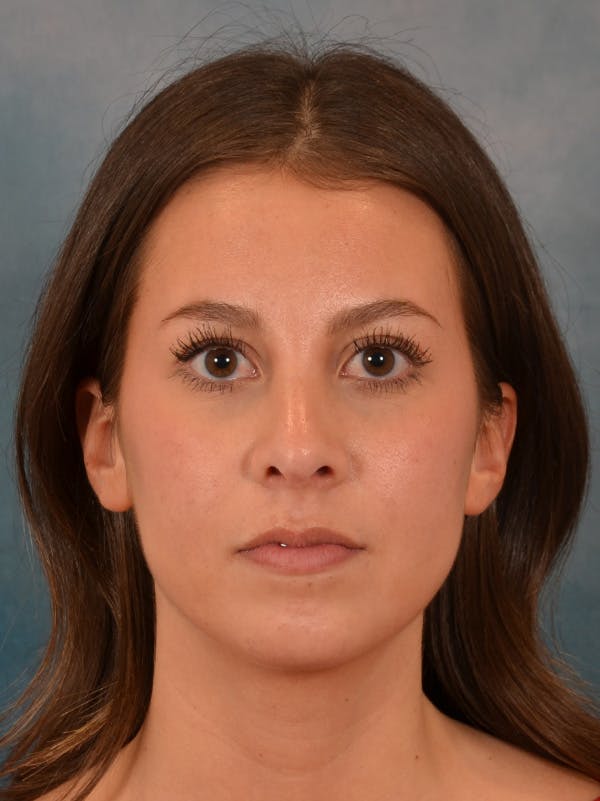 Rhinoplasty Before & After Gallery - Patient 544468 - Image 6