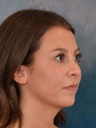 Rhinoplasty Before & After Gallery - Patient 544468 - Image 8