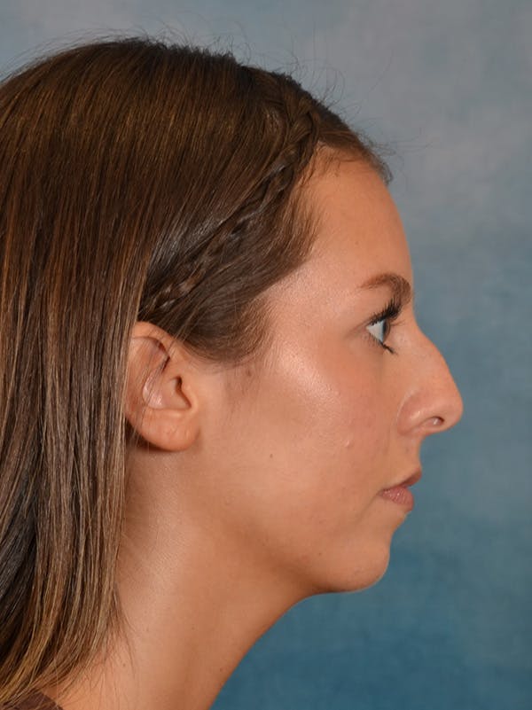 Rhinoplasty Before & After Gallery - Patient 544468 - Image 9