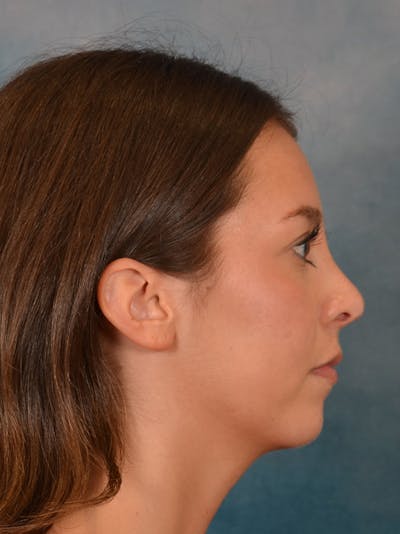 Rhinoplasty Before & After Gallery - Patient 544468 - Image 10