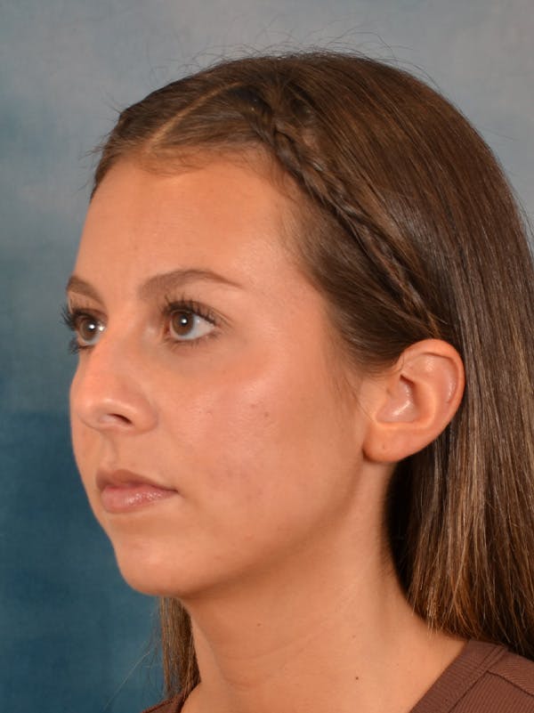 Rhinoplasty Before & After Gallery - Patient 544468 - Image 3