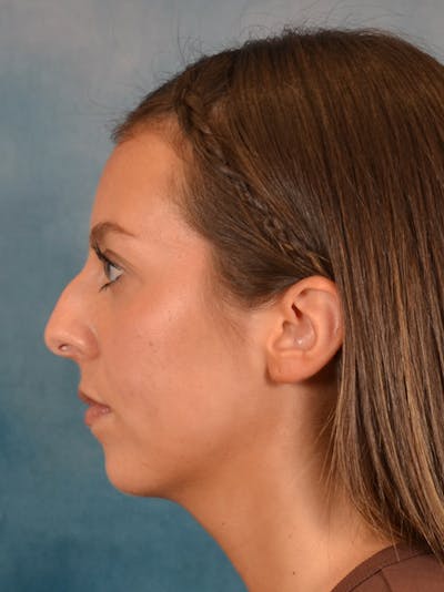 Rhinoplasty Before & After Gallery - Patient 544468 - Image 1
