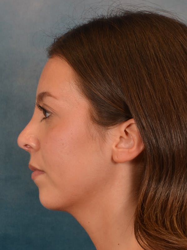 Rhinoplasty Before & After Gallery - Patient 544468 - Image 2