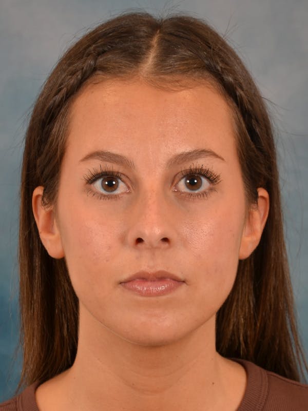 Rhinoplasty Before & After Gallery - Patient 544468 - Image 5