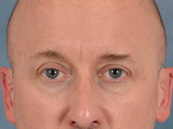 Eyelid Lift Before & After Gallery - Patient 605463 - Image 1