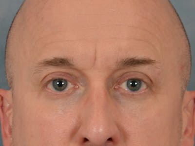 Eyelid Lift Before & After Gallery - Patient 605463 - Image 2