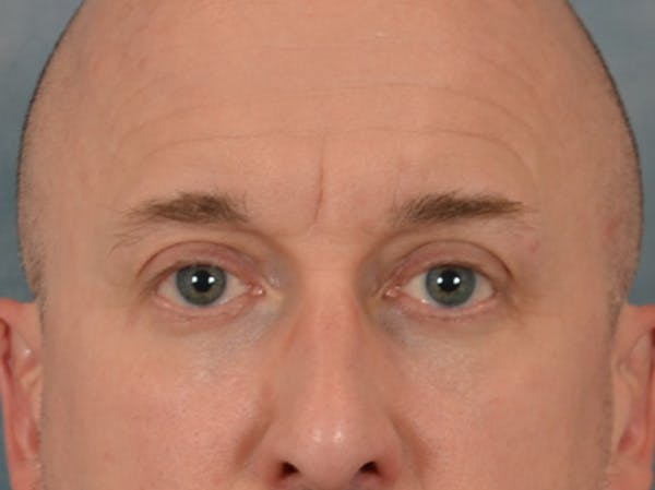 Eyelid Lift Before & After Gallery - Patient 605463 - Image 2