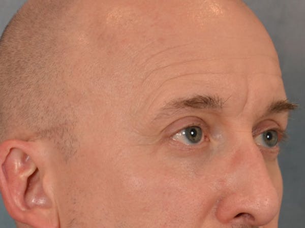 Eyelid Lift Before & After Gallery - Patient 605463 - Image 4