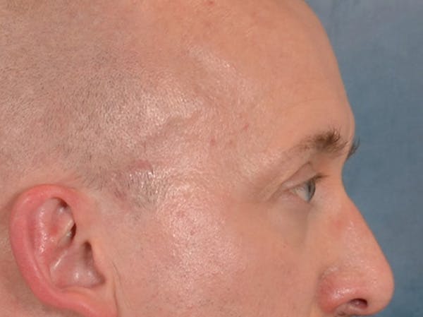 Eyelid Lift Before & After Gallery - Patient 605463 - Image 5