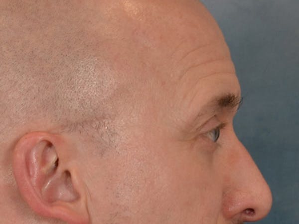 Eyelid Lift Before & After Gallery - Patient 605463 - Image 6