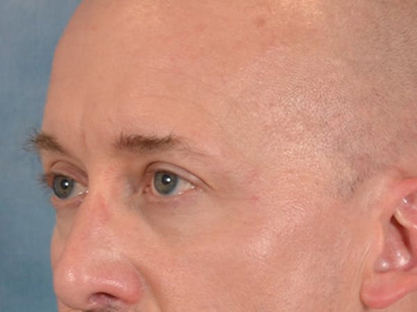 Eyelid Lift Before & After Gallery - Patient 605463 - Image 7